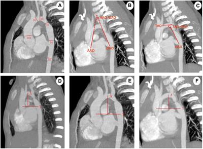 Using computed tomography angiography and computational fluid dynamics to study aortic coarctation in different arch morphologies